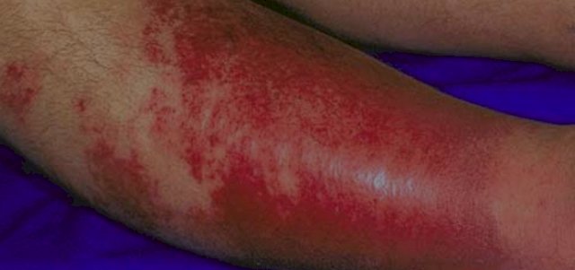 Perna de um paciente com erisipela; ferimento é mais comum nos membros inferiores. (Foto: Revista Saúde/Reprodução)